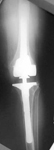 Virigina, Follow up thumbnail of an X-ray, Limb Lengthening, Valgus, Knock knee, deformity correction, Total Knee Replacement