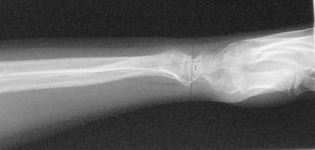 Eve, Post-op thumbnail of an x-ray, Limb Lengthening, radius lengthened, ilizarov/taylor spatial frame, wrist deformity correction