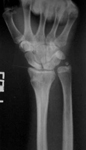 Eve, Pre-op thumbnail of an x-ray, Limb Lengthening, Wrist Deformity, Injured Growth Plate