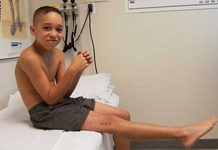Jacob, Follow up thumbnail of an x-ray, Limb Lengthening, gradual leg lengthening, pediatric, leg lengthen correction