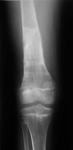Jacob, Follow up thumbnail image, Limb Lengthening, gradual leg lengthening, pediatric, leg lengthen correction