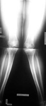 Yesinia, Pre-op thumbnail of an x-ray, Limb Lengthening, Genu Valgum, Knock-knee deformity