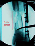 Nicholas, Pre-Op thumbnail of an X-ray, Limb Lengthening, Limb Salvage, Bone Transport, Tibia