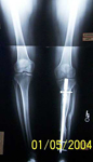 Marcelle, Follow up thumbnail of an x-ray, Limb Lengthening, tibia healed, Bone Transport 