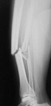 Marcelle, Pre-op thumbnail of an X-ray, Limb Lengthening, infected tibia nonunion