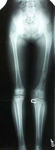 Jocelyn, Follow up thumbnail of an x-ray, Limb Lengthening, Pediatric, femur lengthened
