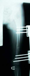 Jocelyn, Post-Op thumbnail of an x-ray, Limb Lengthening, Pediatric, femur osteotomy, hemispiphyseal stapling