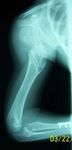 Taylor, Pre-Op thumbnail of an X-ray, Limb Lengthening, Humerus, Ollier's Disease, deformed humerus