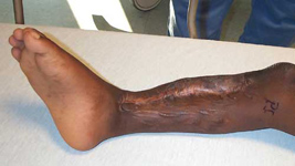 Lansana, Pre-Op thumbnail Image, Limb Lengthening, Limb Salvage, tibial bone defect