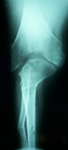 Steven, Post-op thumbnail of an x-ray, Limb Lengthening, tibia and fibula osteotomy, ilizarov/taylor spatial frame