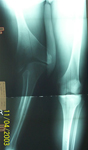 Steven, Pre-op thumbnail of an x-ray, Limb Lengthening, congential leg deformity, valgus