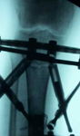Jeanne, Post-op thumbnail of an X-ray, Limb Lengthening, Ilizarov/Taylor Spatial Frame, proximal tibial osteotomy