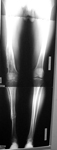 Sean, Follow up thumbnail of an x-ray, limb lengthening, deformity corrected, leg lengthened, correction of femur malunion