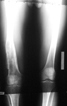Sean, Follow up thumbnail of an x-ray, limb lengthening, deformity corrected, leg lengthened, correction of femur malunion