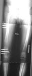 Sean, Post-op thumbnail of an x-ray, limb lengthening, osteotomy, femur osteotomy, monolateral frame, gradual lengthening