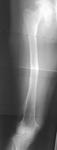 Sean, Pre-op thumbnail of an x-ray, limb lengthening, fractured femur, valgus, deformity