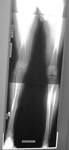 Sean, Pre-op thumbnail of an x-ray, limb lengthening, fractured femur, valgus, deformity