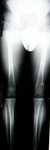 Andrew, Follow up thumbnail of an x-ray, Limb Lengthening, undue stress removed from lateral joint compartment of the knee