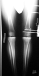 Andrew, Post-Op thumbnail of an x-ray, Limb Lengthening, osteotomy, distal femur, minimally invasive surgery 