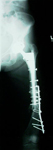 Roberta, Pre-op thumbnail x-ray, limb lengthening, femoral nonunion with deformity below hip replacement 