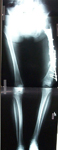 Roberta, Pre-op thumbnail of an x-ray, limb lengthening, femoral nonunion with deformity below hip replacement 