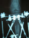 Natalie, Post Op thumbnail of an x-ray, Limb Lengthening, repaired nonunion, Tibia lengthened