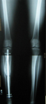Ian, Follow up thumbnail of an x-ray Image, limb lengthening, rod inserted to support new bone  