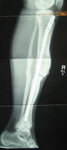 Ian, Follow up thumbnail of an x-ray Image, limb lengthening, rod inserted to support new bone  