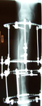 Ian, Post Op thumbnail of an x-ray Image, limb lengthening, 2 areas of bone lengthening, no bone defect