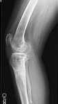 Renee, Follow up thumbnail of anx-ray Image, Limb Lengthening, Knee and back pain have improved, leg straightened