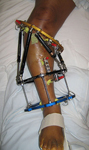 Renee, Post-op thumbnail Image, Limb Lengthening, Taylor Spatial Frame to straighten and lengthen