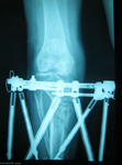 Renee, Post-op thumbnail of an X-ray Image, Limb Lengthening, Taylor Spatial Frame to straighten and lengthen