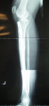 thumbnail of an x-ray of Kim's leg, follow up image, lengthened leg, knee and back pain have improved, Limb Lengthening