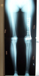 Thumbnail X-ray Follow up, deformity corrected, Limb Lengthening 