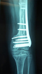 thumbnail, x-ray, Follow up, deformity corrected, Limb Lengthening 