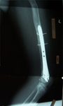 Thumbnail, x-ray, Karina Follow up, deformity corrected, Limb Lengthening