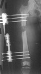 John, post-op Image, Bone transport in femur for a 10 cm defect