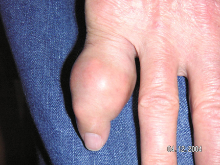 Photo showing large tophus of a finger