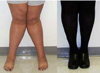 Image of knock knees before and after