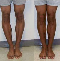 Image of bowlegs before and after