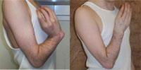 Before and after photo of Radial Club Hand Wrist/Forearm Deformity
