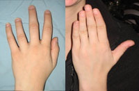 Before and after photo of Metacarpal (finger) lengthening