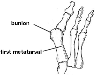 bunion and first metatarsal bone, labeled