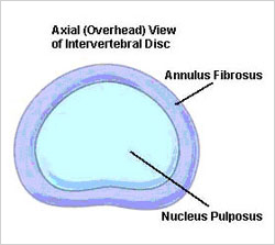 Diagram showing overhead view of a lumbar spinal disc.