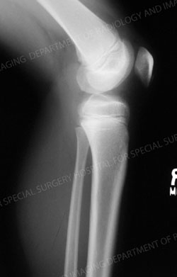 X-ray image of normal pediatric knee