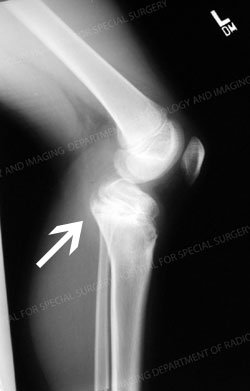 X-ray image of growth plate injury