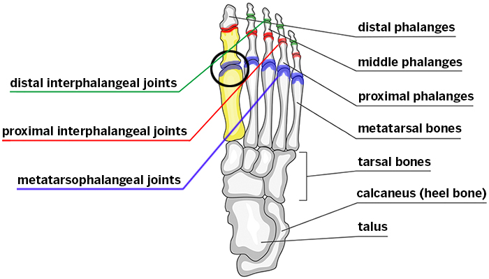 Foot anatomy showing the joint and bones affected by hallux rigidus