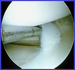 meniscus scope surgery