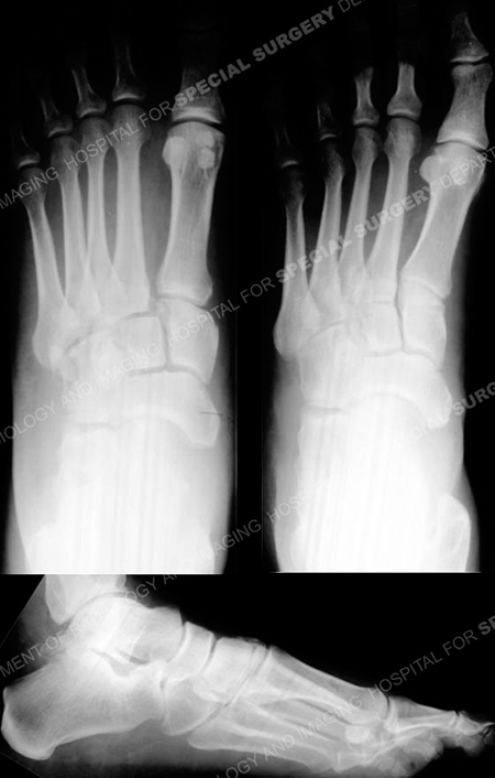 Anteroposterior, oblique and lateral radiographs revealing a Lisfranc fracture- dislocation from a case example from the Orthopedic Trauma Service at Hospital for Special Surgery
