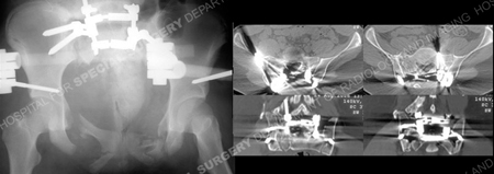 radiographs following fracture reduction and ct-scan from a case example of pediatric pelvic fracture from the orthopedic trauma service at Hospital for Special Surgery.